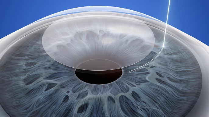 Silk極飛秒近視雷射