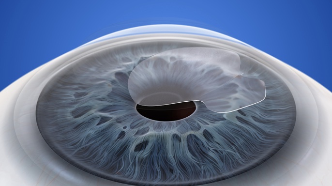 Silk極飛秒近視雷射