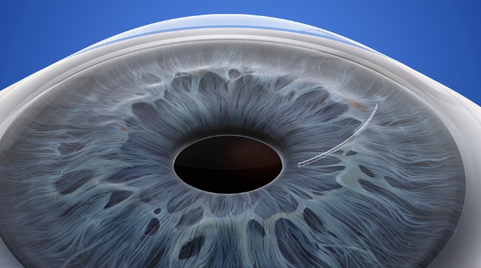 Silk極飛秒近視雷射