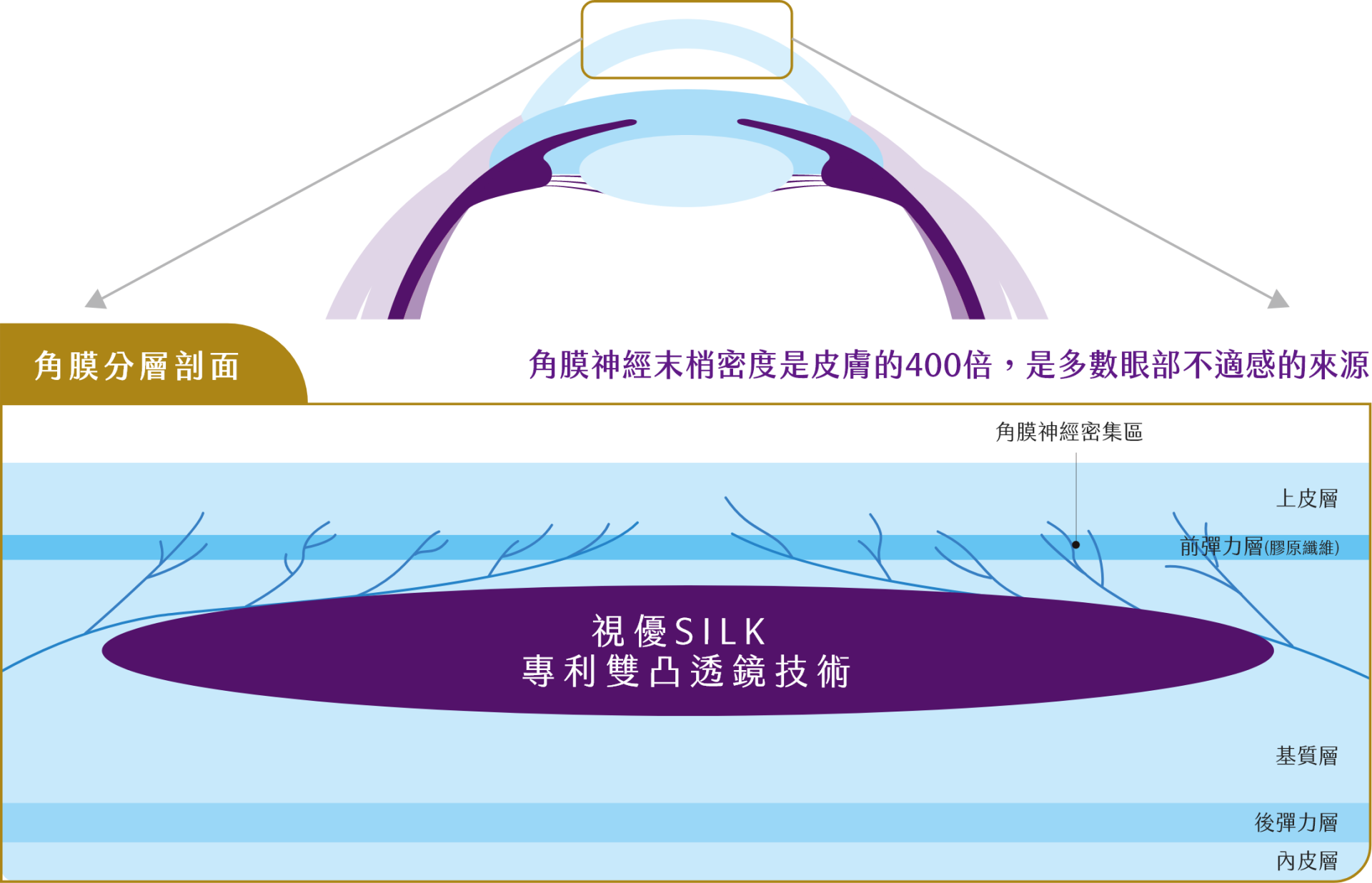 Silk極飛秒近視雷射