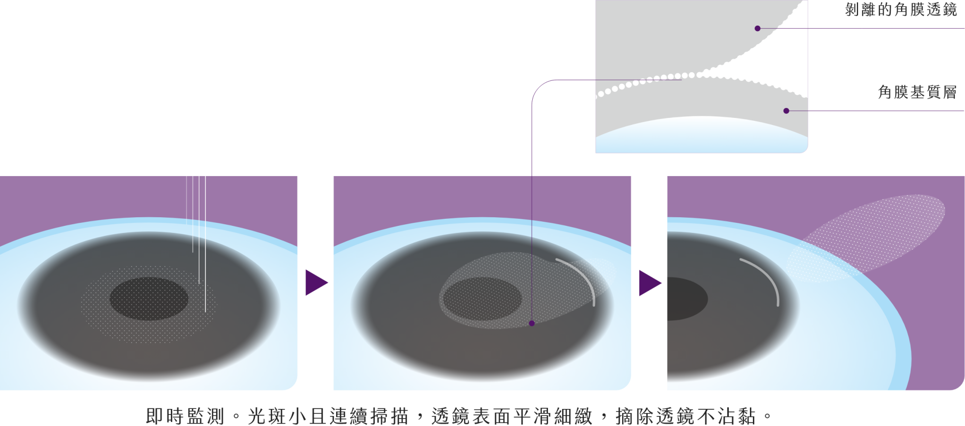 Silk極飛秒近視雷射